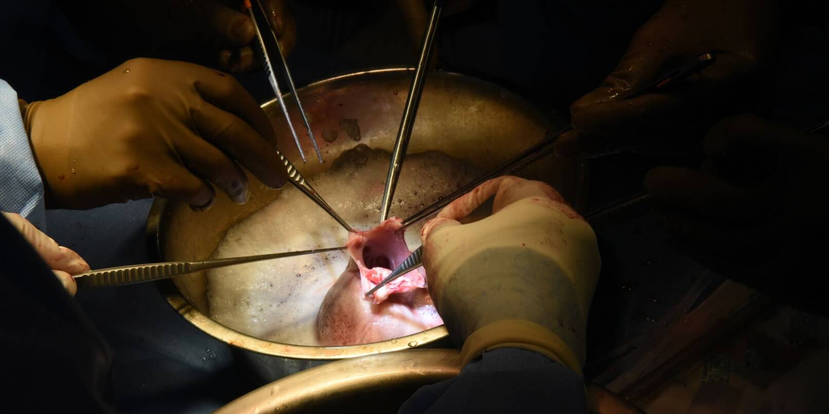 Chirurgen führen die Transplantation des Schweineherzens im Krankenhaus in Baltimore durch.