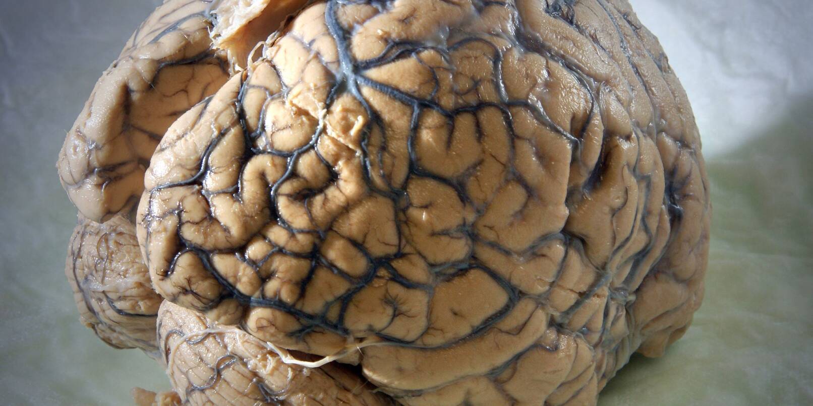 Ein Gehirn des Menschen in einem Labor der Klinik für Neurologie am Universitätsklinikum Jena.