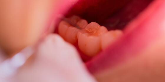 Zahnarzt bohrt versehentlich Schraube in Gehirn von Patient
