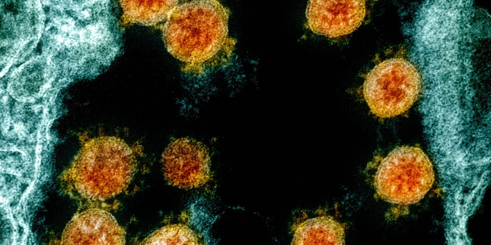 Partikel des Coronavirus SARS-CoV-2 wurden für eine elektronenmikroskopische Aufnahme am «National Institute of Allergy and Infectious Diseases Integrated Research Facility» farblich bearbeitet.