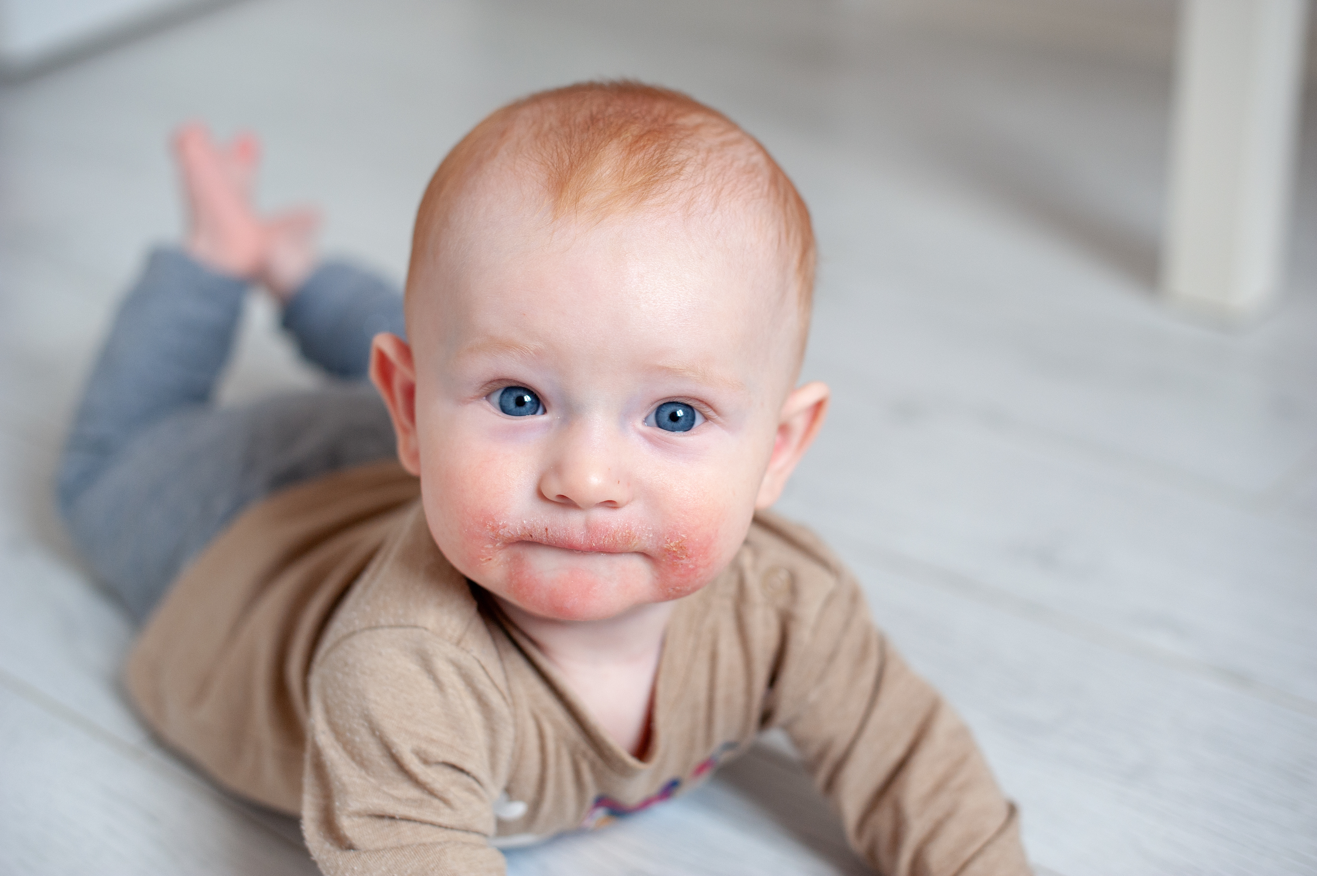 When children's skin burns: What really helps with eczema