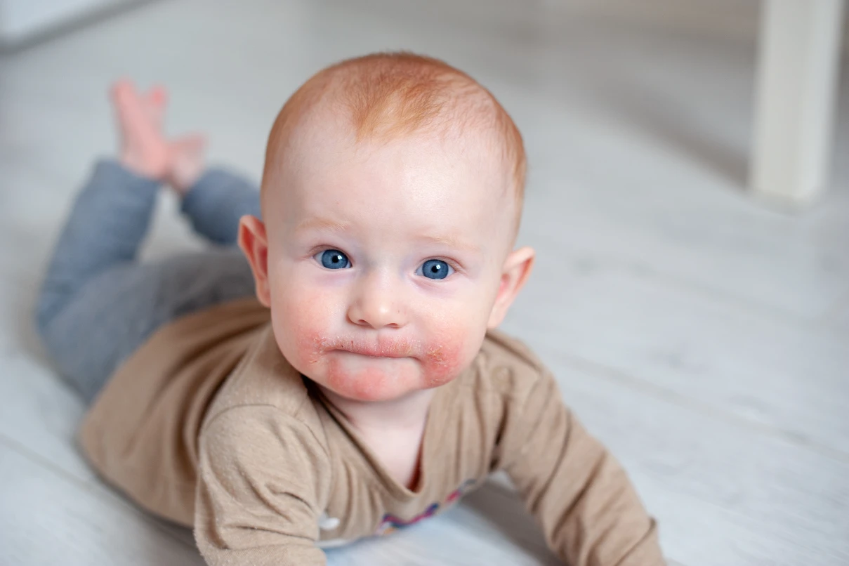 When children's skin burns: What really helps with eczema